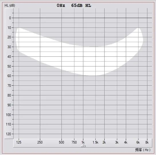 【听力科普】言语香蕉图—“香蕉”是怎样炼成的(图2) 【听力科普】言语香蕉图—“香蕉”是怎样炼成的(图2)